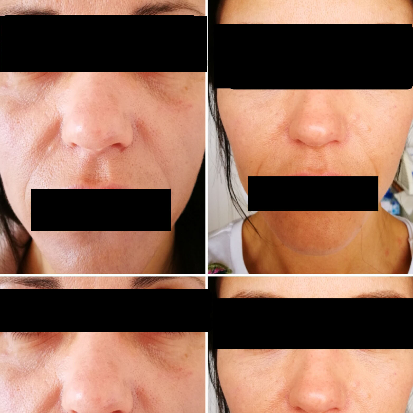 Nose to mouth wrinkle skin fillers
