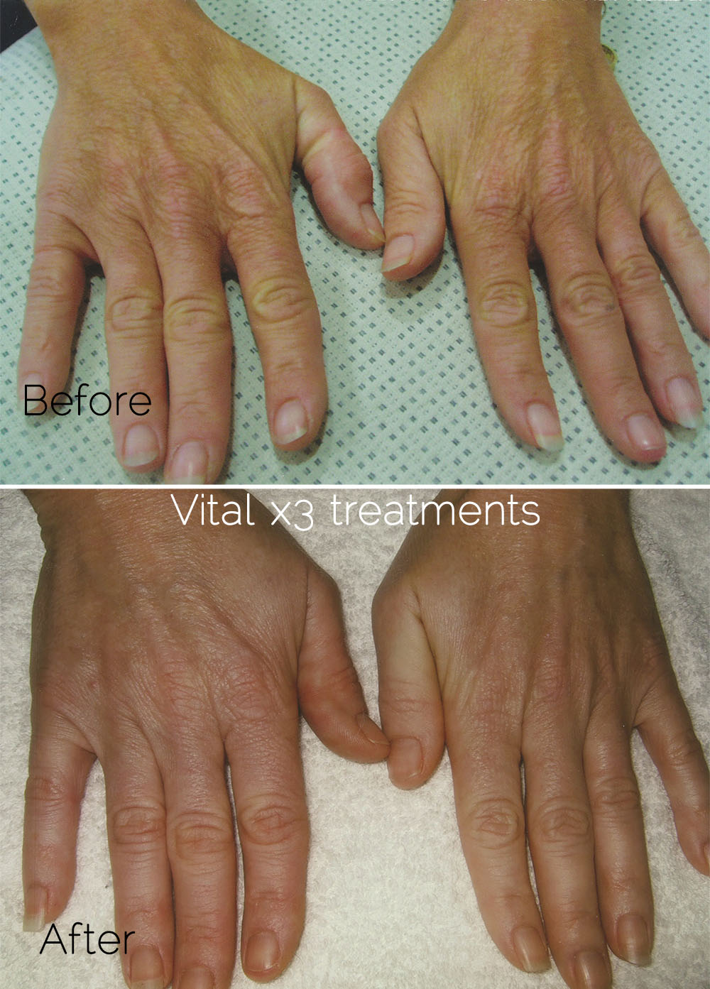 After Vital 3 treatment on hands